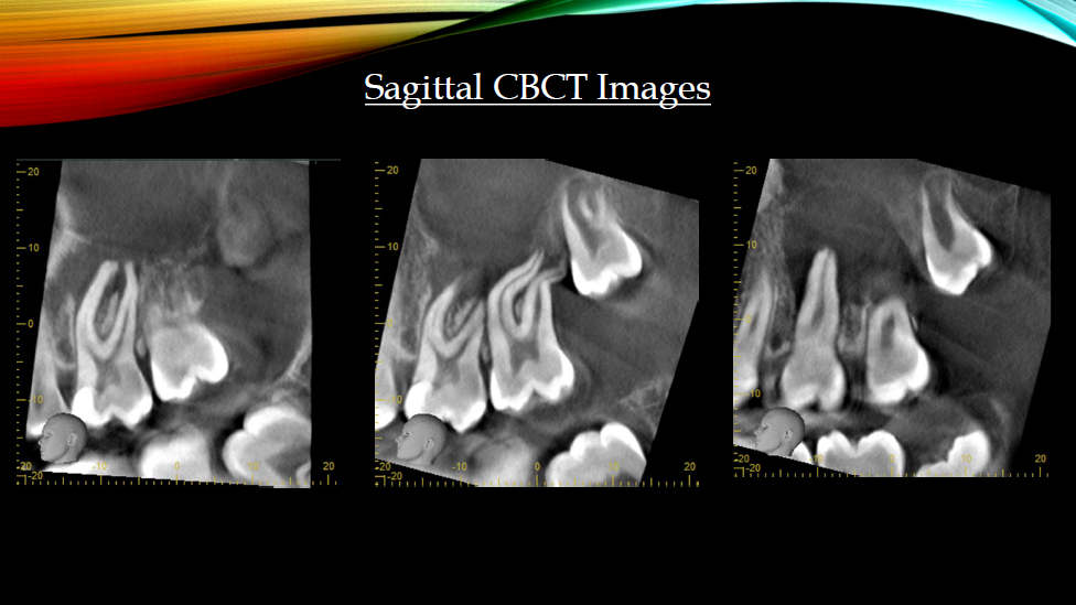 aspen endo - sagittal cbct images